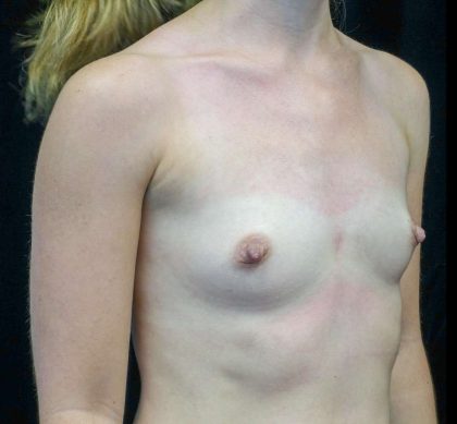 Breast Augmentation (Implants) Before & After Patient #21279