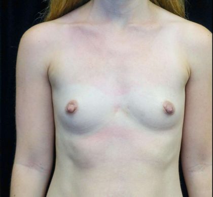 Breast Augmentation (Implants) Before & After Patient #21279