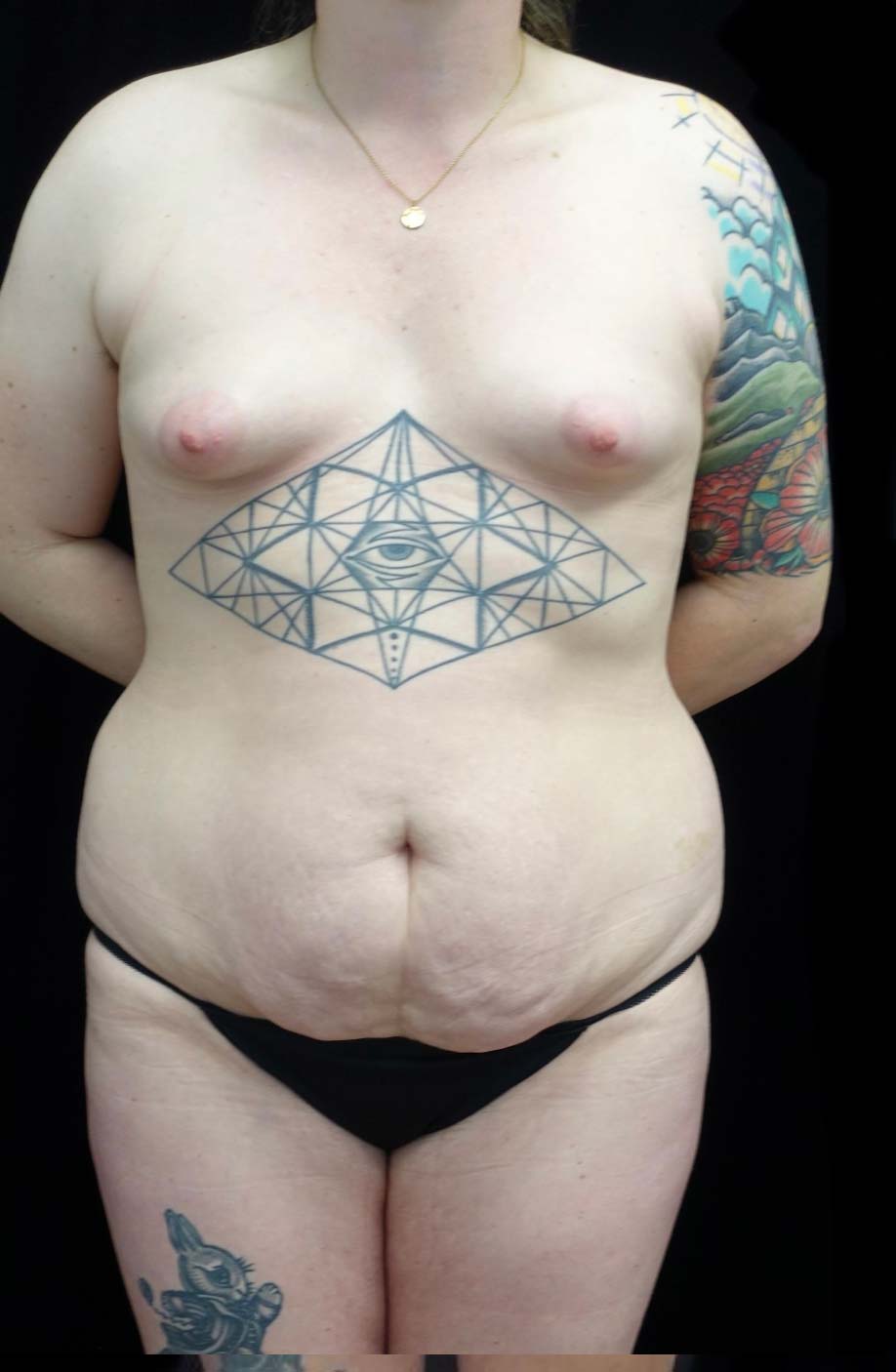 Breast Augmentation (Implants) Before & After Patient #21287