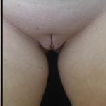 Labiaplasty Before & After Patient #21301