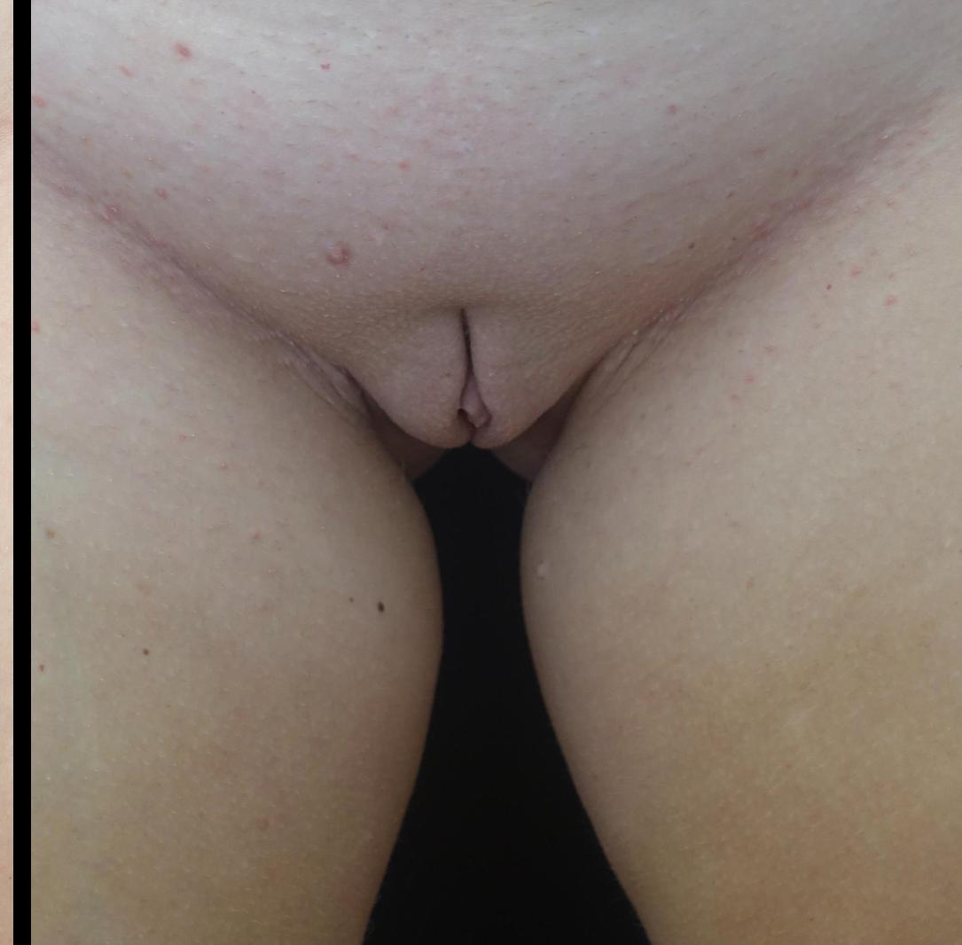 Labiaplasty Before & After Patient #21301
