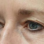 Blepharoplasty Before & After Patient #21443