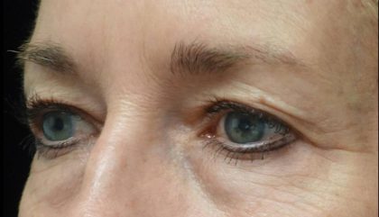 Blepharoplasty Before & After Patient #21443