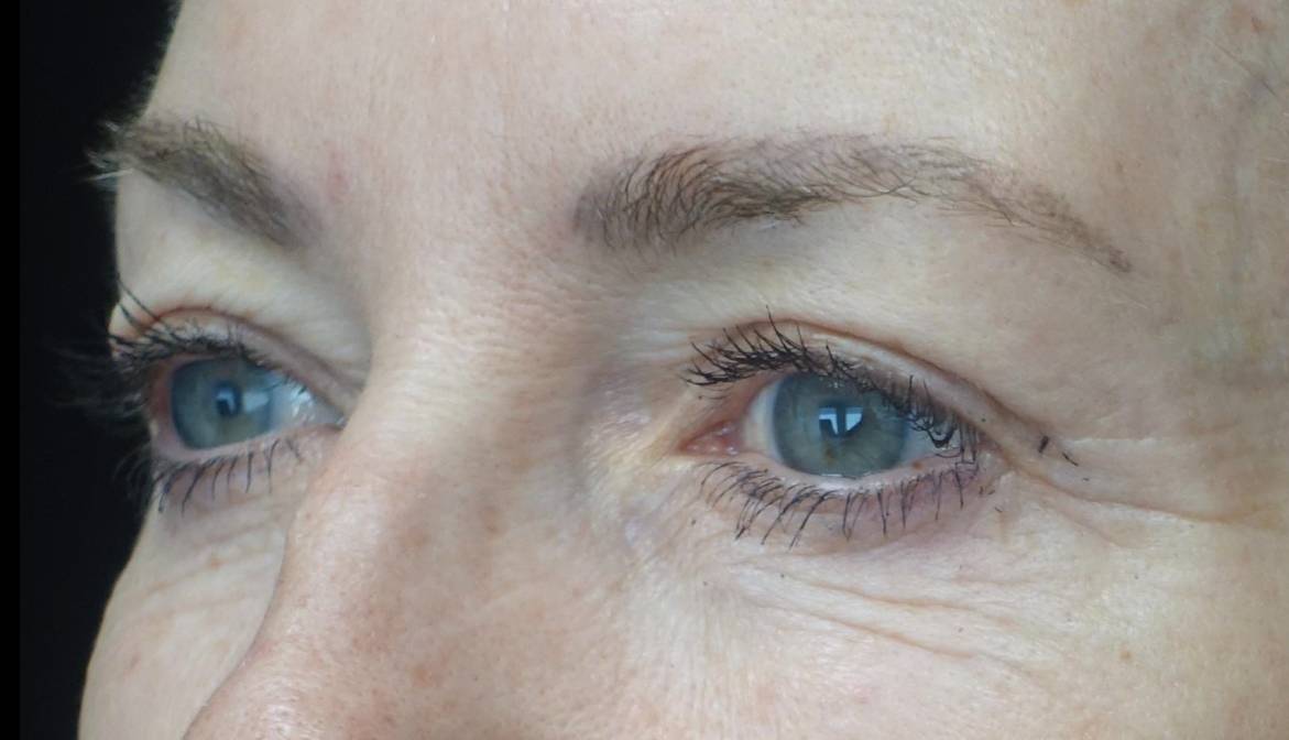 Blepharoplasty Before & After Patient #21443