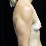 Breast Augmentation (Implants) Before & After Patient #21307