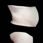 Lipoabdominoplasty Before & After Patient #21455