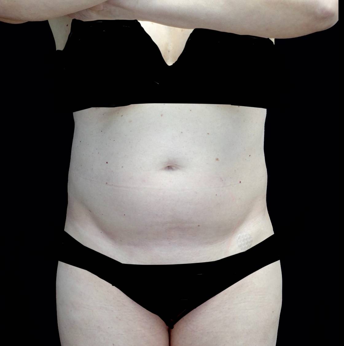 Lipoabdominoplasty Before & After Patient #21455