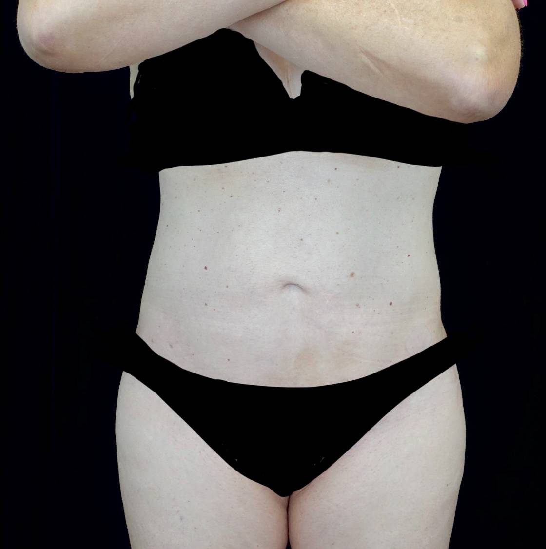 Lipoabdominoplasty Before & After Patient #21455