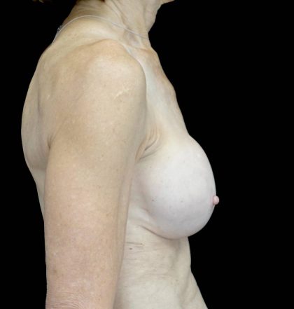 Breast Revision Before & After Patient #21462