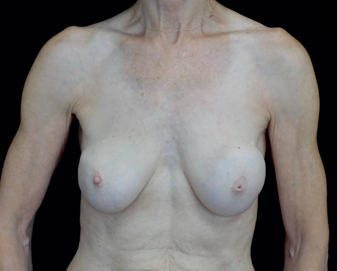 Breast Revision Before & After Patient #21462
