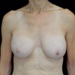 Breast Revision Before & After Patient #21462