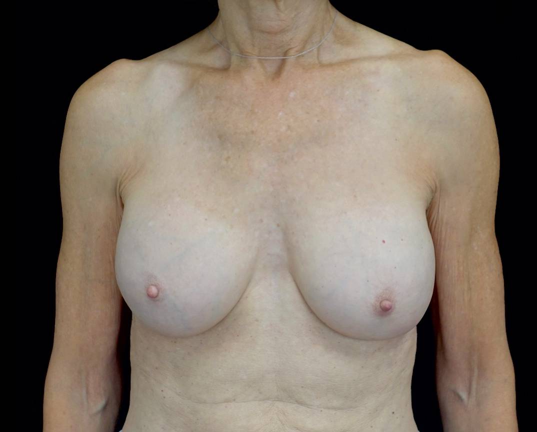 Breast Revision Before & After Patient #21462