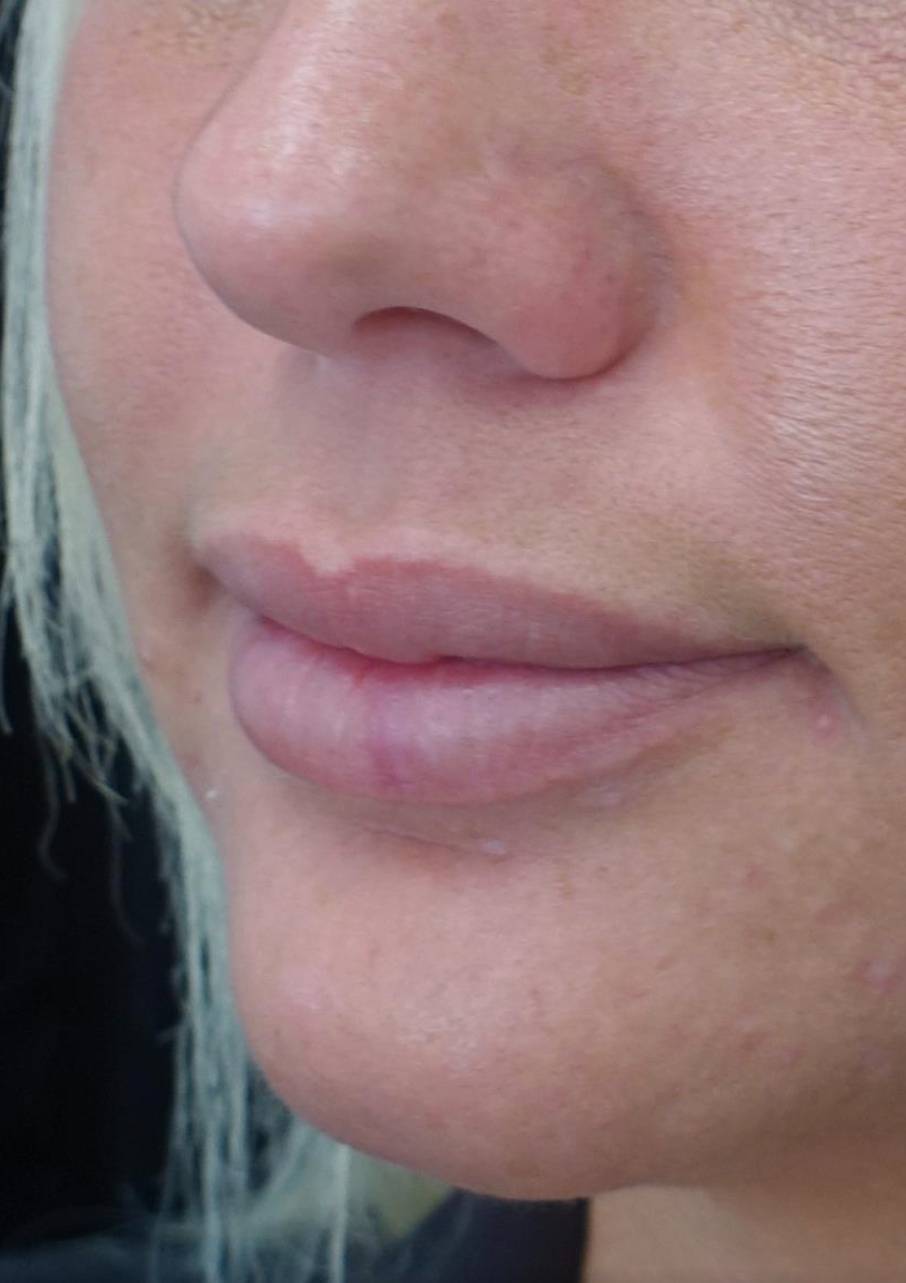 Lip Augmentation - Fillers Before & After Patient #21438
