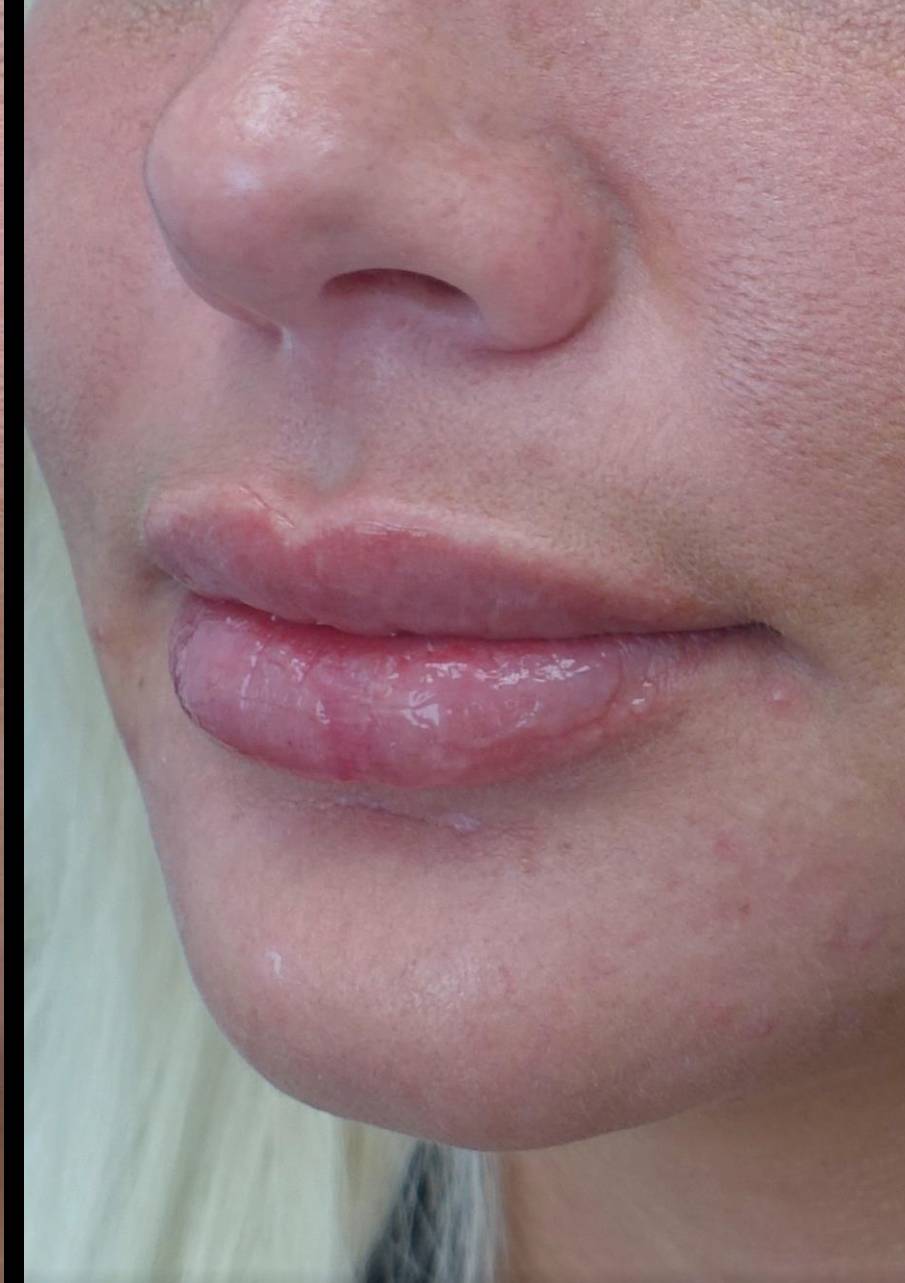 Lip Augmentation - Fillers Before & After Patient #21438
