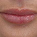 Lip Augmentation - Fillers Before & After Patient #21438