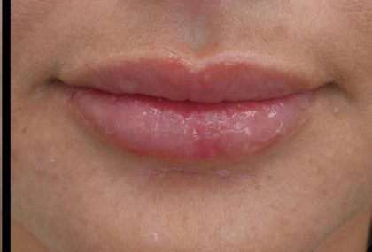Lip Augmentation - Fillers Before & After Patient #21438