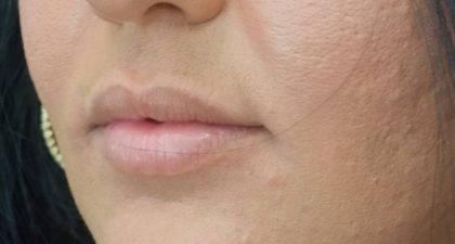 Lip Augmentation - Fillers Before & After Patient #21448
