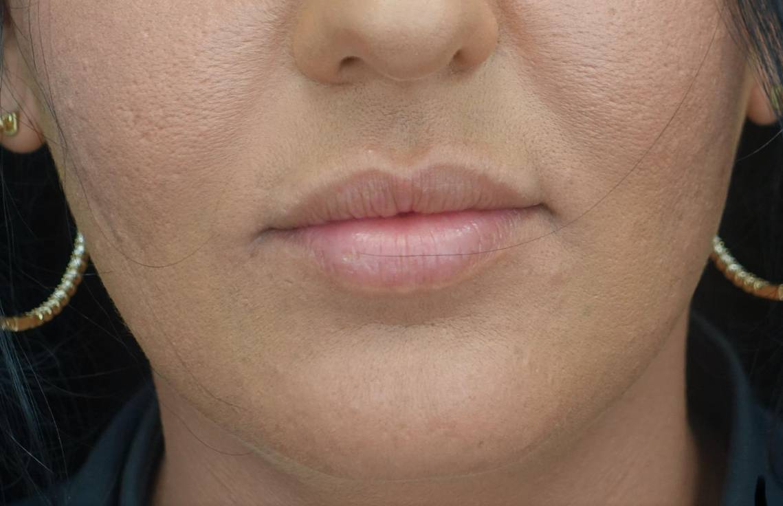 Lip Augmentation - Fillers Before & After Patient #21448