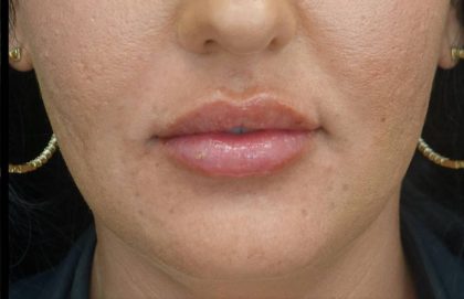 Lip Augmentation - Fillers Before & After Patient #21448