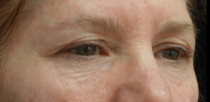 Blepharoplasty Before & After Patient #21469