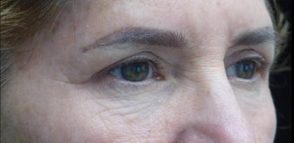 Blepharoplasty Before & After Patient #21469