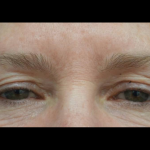 Blepharoplasty Before & After Patient #21469