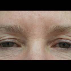 Blepharoplasty Before & After Patient #21469