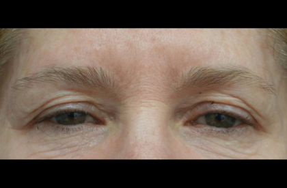 Blepharoplasty Before & After Patient #21469