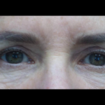 Blepharoplasty Before & After Patient #21469