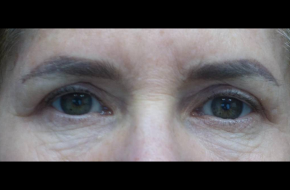 Blepharoplasty Before & After Patient #21469
