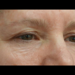 Blepharoplasty Before & After Patient #21469