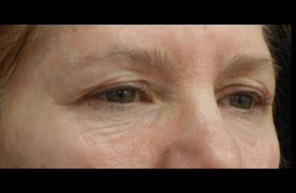 Blepharoplasty Before & After Patient #21469