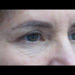 Blepharoplasty Before & After Patient #21469