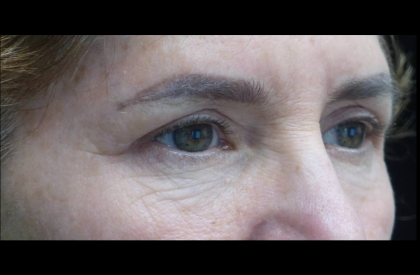 Blepharoplasty Before & After Patient #21469