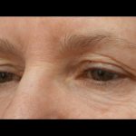 Blepharoplasty Before & After Patient #21469