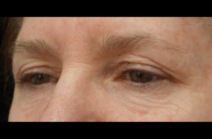 Blepharoplasty Before & After Patient #21469