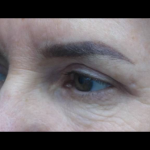 Blepharoplasty Before & After Patient #21469
