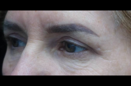 Blepharoplasty Before & After Patient #21469