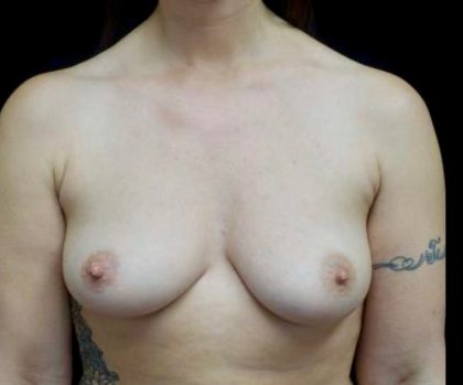 Breast Augmentation (Implants) Before & After Patient #21574