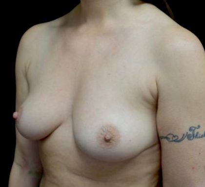 Breast Augmentation (Implants) Before & After Patient #21574