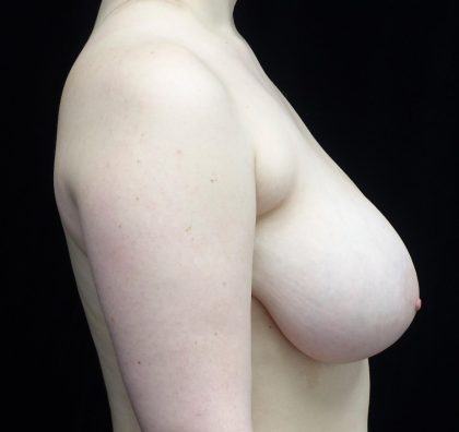 Breast Reduction Before & After Patient #21533