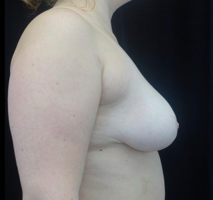 Breast Reduction Before & After Patient #21533