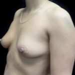 Breast Augmentation (Implants) Before & After Patient #21573