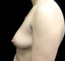 Breast Augmentation (Implants) Before & After Patient #21573