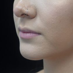 Lip Augmentation - Fillers Before & After Patient #21656