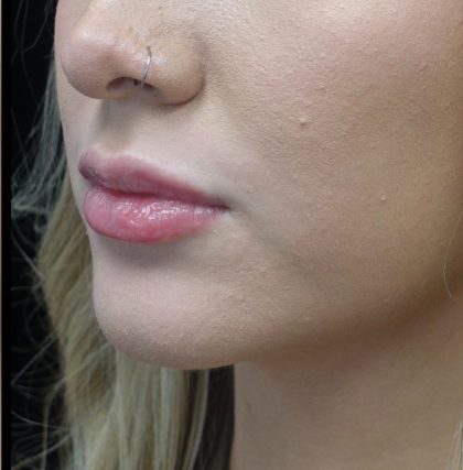 Lip Augmentation - Fillers Before & After Patient #21656