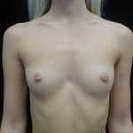 Breast Augmentation (Implants) Before & After Patient #21558