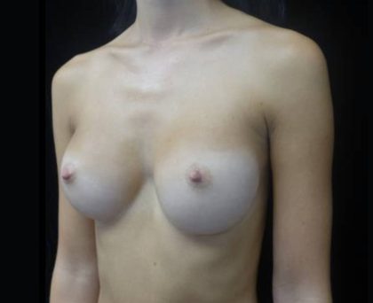 Breast Augmentation (Implants) Before & After Patient #21558