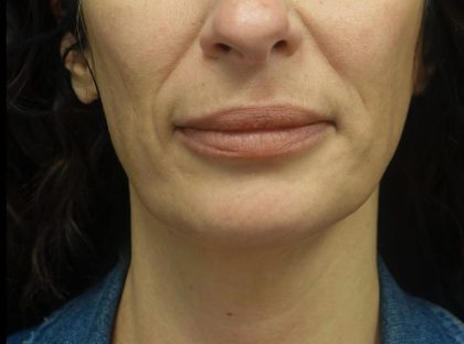 Lip Augmentation - Fillers Before & After Patient #21782
