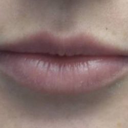 Fillers & Injectables Before & After Patient #21813